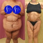 Tummy Tuck (Abdominoplasty) Super Plus Size Before & After Patient #14530