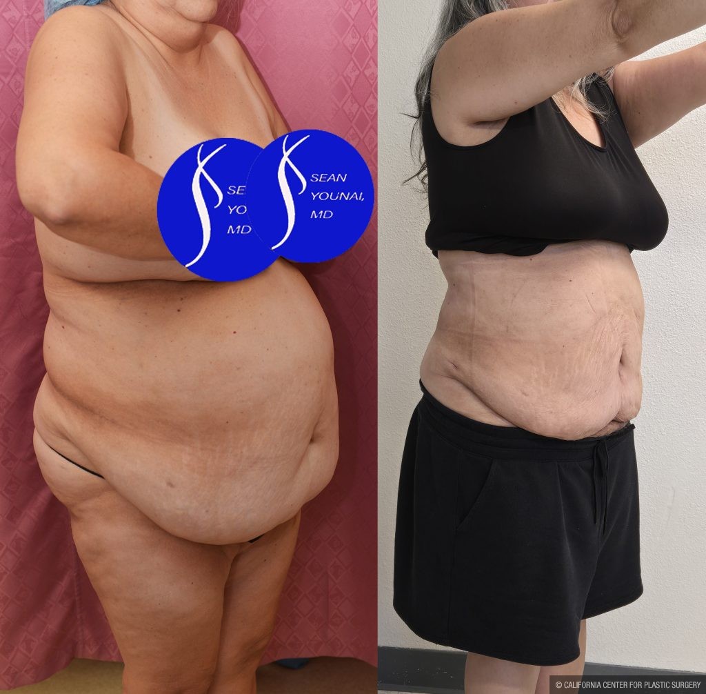 Liposuction Abdomen Plus Size Before & After Patient #14528