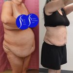 Liposuction Abdomen Plus Size Before & After Patient #14528