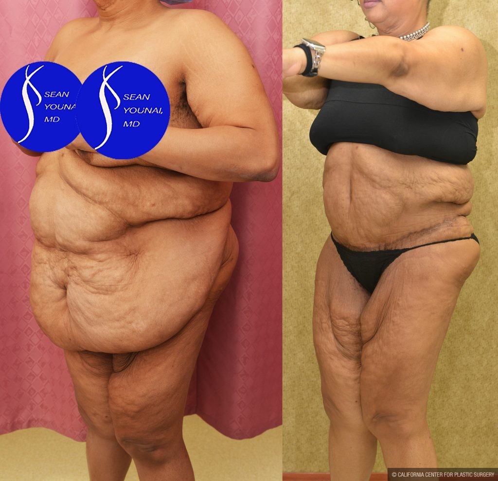 Tummy Tuck (Abdominoplasty) Super Plus Size Before & After Patient #14530
