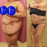 Tummy Tuck (Abdominoplasty) Super Plus Size Before & After Patient #14530
