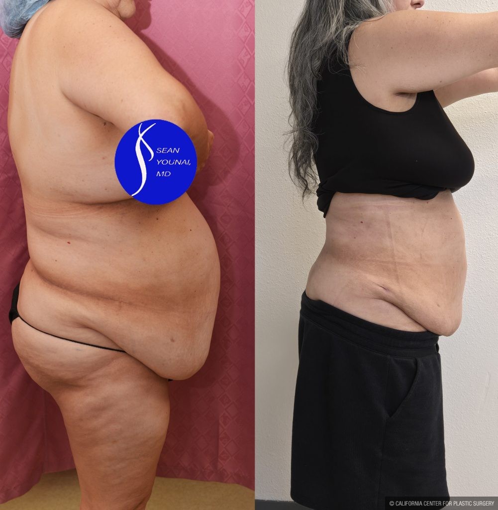 Liposuction Abdomen Plus Size Before & After Patient #14528