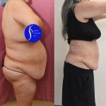 Liposuction Abdomen Plus Size Before & After Patient #14528