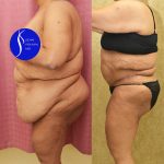 Tummy Tuck (Abdominoplasty) Super Plus Size Before & After Patient #14530
