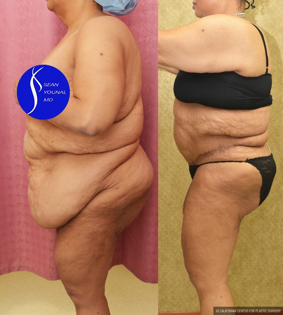 Tummy Tuck (Abdominoplasty) Super Plus Size Before & After Patient #14530
