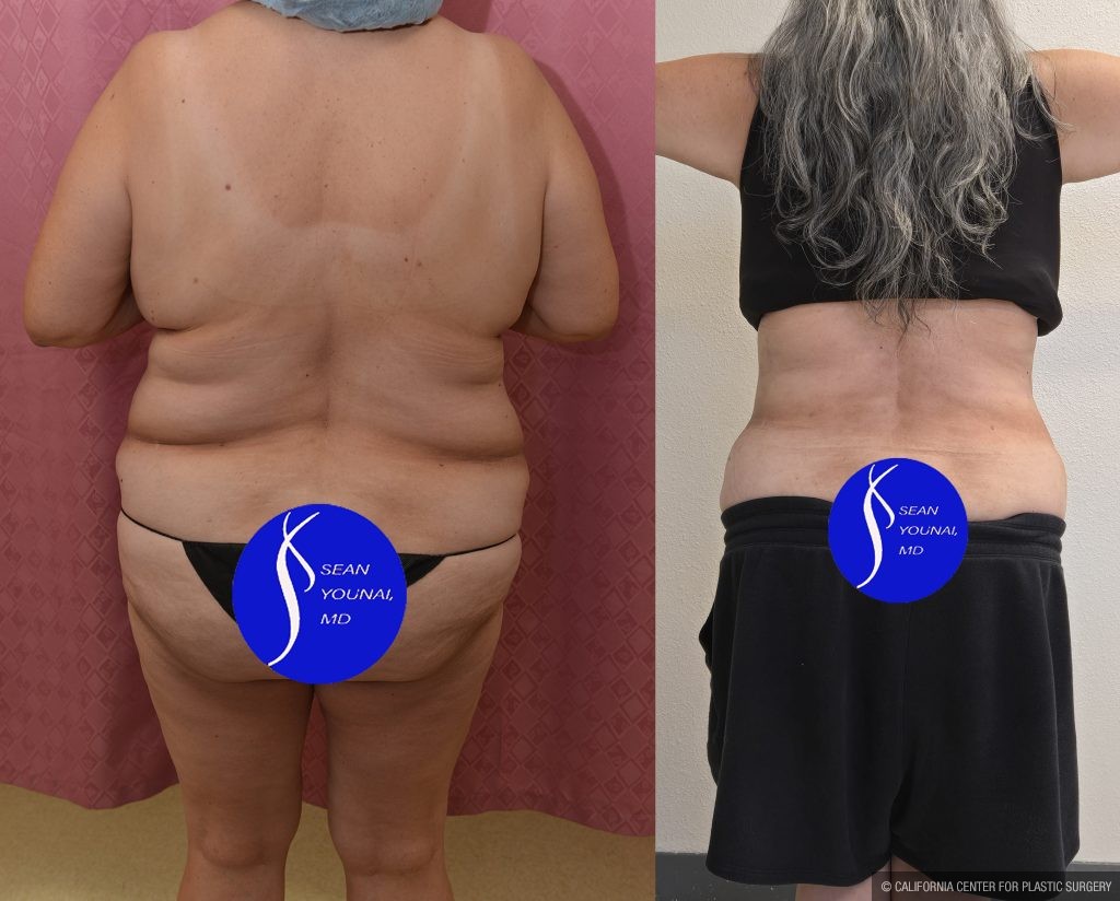 Liposuction Abdomen Plus Size Before & After Patient #14528