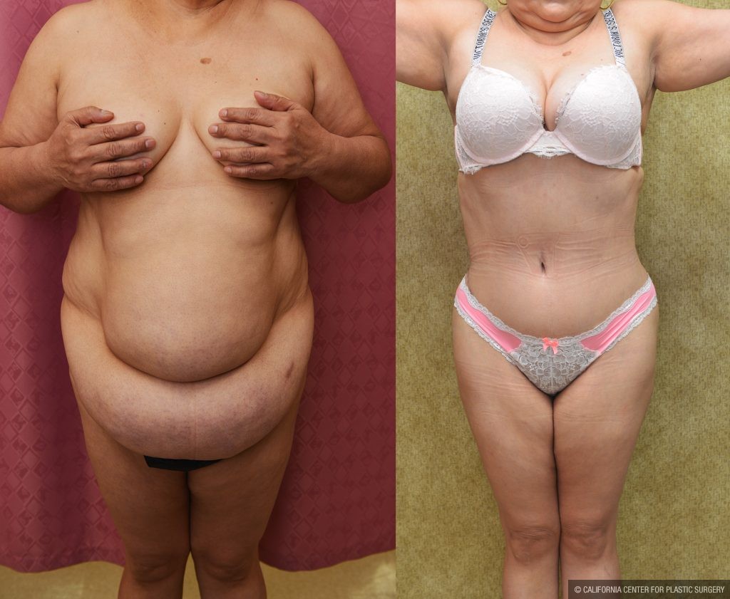Tummy Tuck (Abdominoplasty) Super Plus Size Before & After Patient #14575