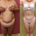 Tummy Tuck (Abdominoplasty) Super Plus Size Before & After Patient #14575