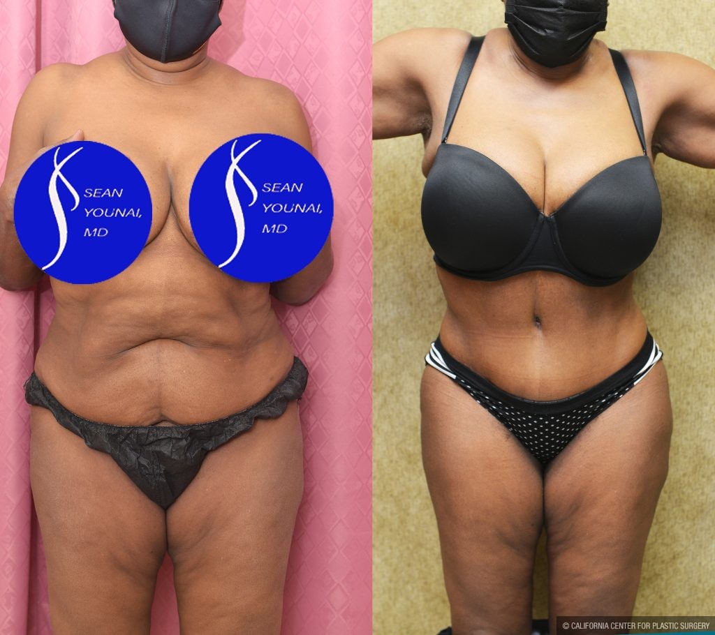 African American Tummy Tuck (Abdominoplasty) Before & After Patient #14586