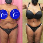 African American Tummy Tuck (Abdominoplasty) Before & After Patient #14586