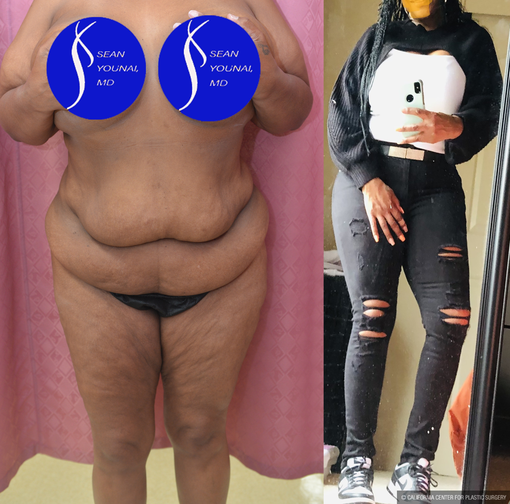 Tummy Tuck (Abdominoplasty) Plus Size Before & After Patient #14576
