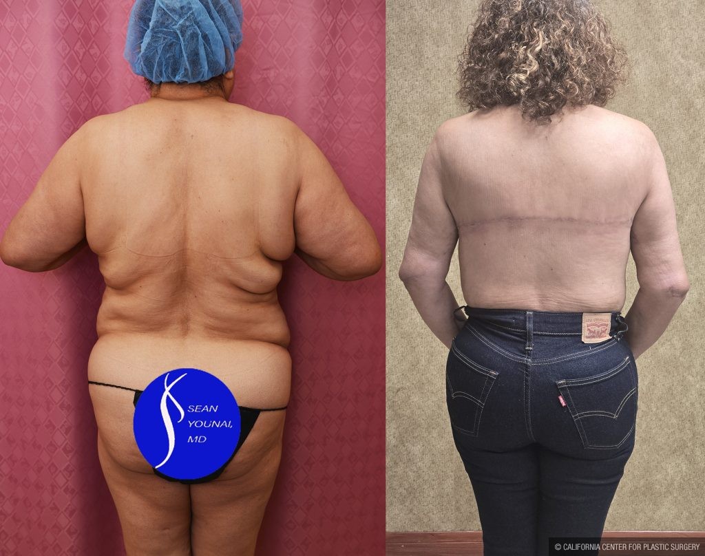 Upper Back Lift Before & After Patient #14574