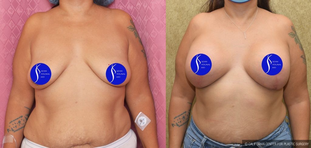 Breast Lift - Full Before & After Patient #14587