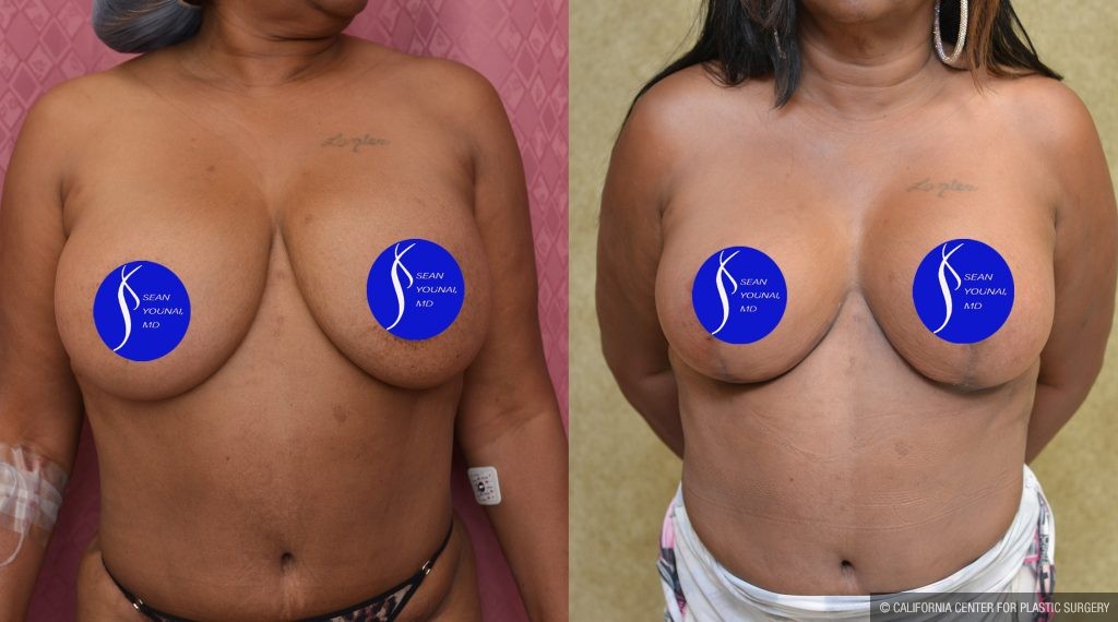 Breast Lift - Full Before & After Patient #14588