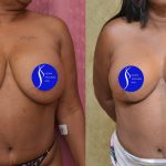 Breast Lift - Full Before & After Patient #14588