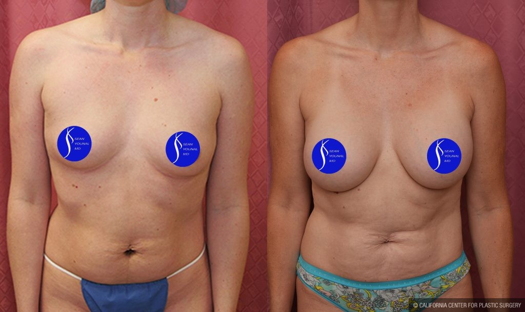 Breast Augmentation Before & After Patient #14589