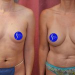 Breast Augmentation Before & After Patient #14589