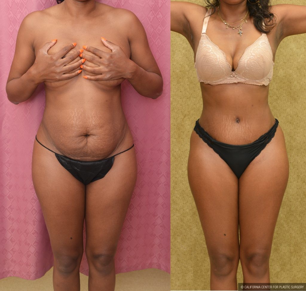Tummy Tuck (Abdominoplasty) Small Size Before & After Patient #14590