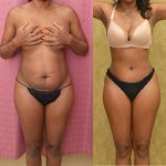 Tummy Tuck (Abdominoplasty) Small Size Before & After Patient #14590