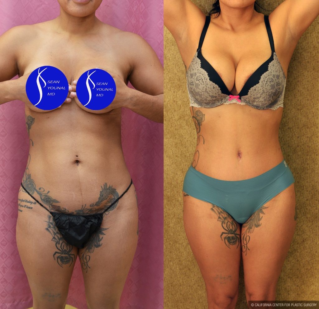 Tummy Tuck (Abdominoplasty) Small Size Before & After Patient #14591