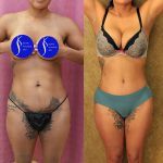Tummy Tuck (Abdominoplasty) Small Size Before & After Patient #14591