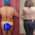 Upper Back Lift Before & After Patient #14574
