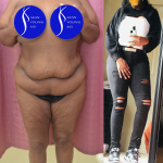 Tummy Tuck (Abdominoplasty) Plus Size Before & After Patient #14576