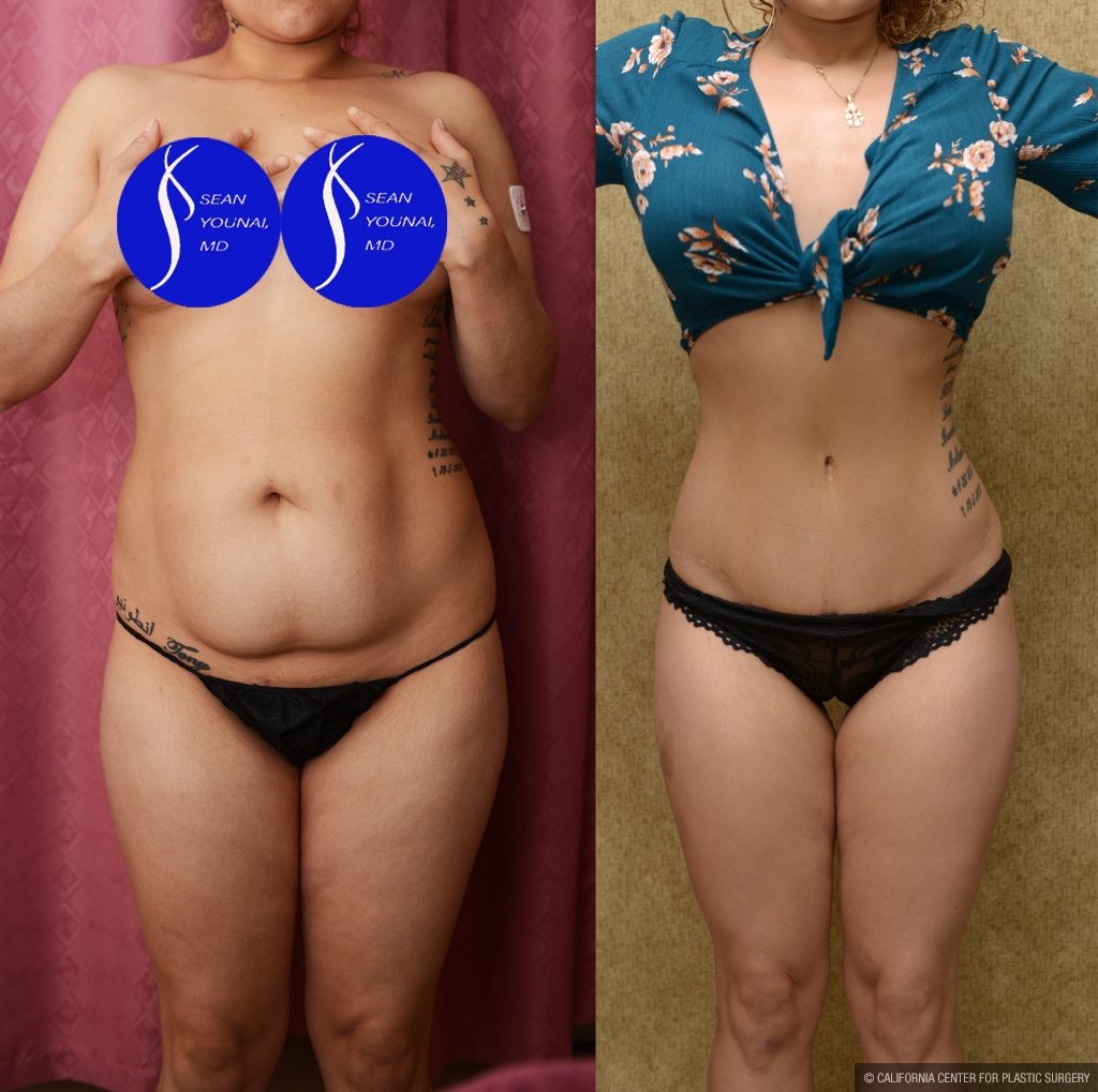 Tummy Tuck (Abdominoplasty) Small Size Before & After Patient #14592