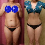 Tummy Tuck (Abdominoplasty) Small Size Before & After Patient #14592