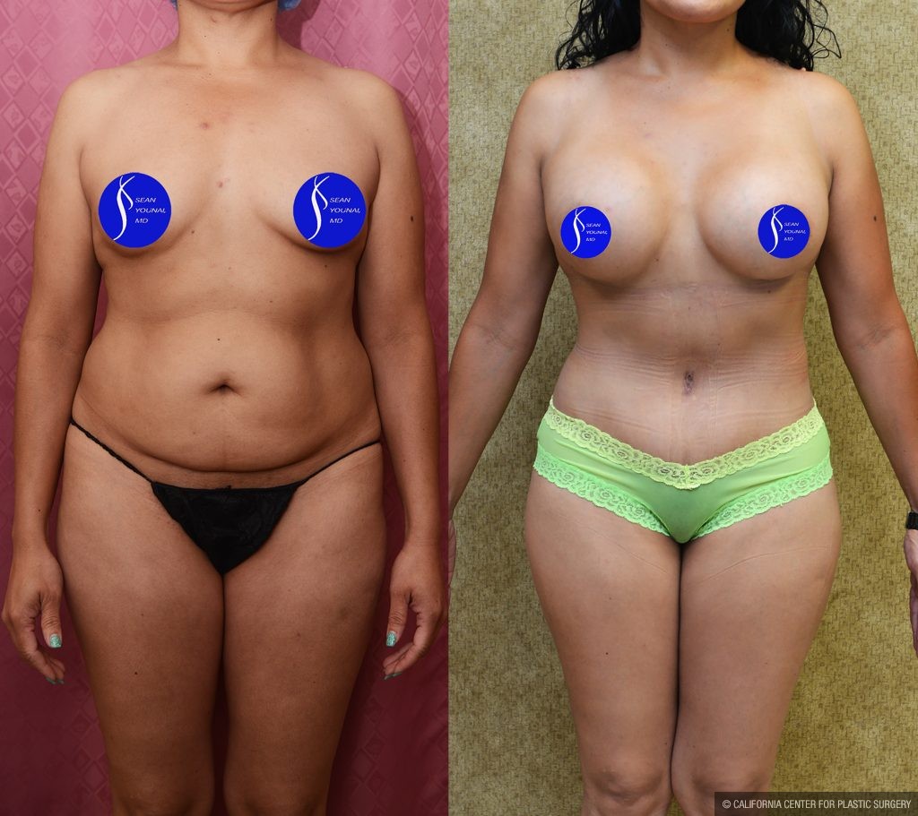 Mommy Makeover Before & After Patient #14593