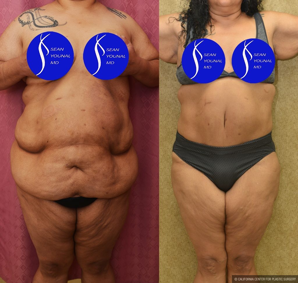Tummy Tuck (Abdominoplasty) Super Plus Size Before & After Patient #14577