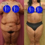 Tummy Tuck (Abdominoplasty) Super Plus Size Before & After Patient #14577