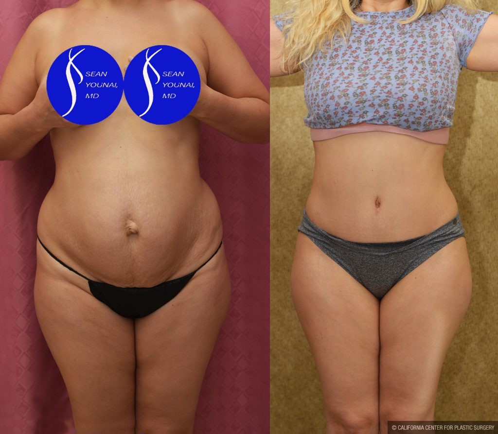 Tummy Tuck (Abdominoplasty) Small Size Before & After Patient #14579