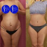Tummy Tuck (Abdominoplasty) Small Size Before & After Patient #14579