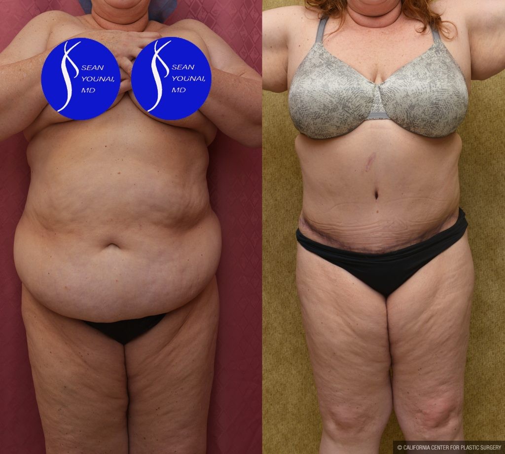 Tummy Tuck (Abdominoplasty) Plus Size Before & After Patient #14580