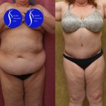 Tummy Tuck (Abdominoplasty) Plus Size Before & After Patient #14580