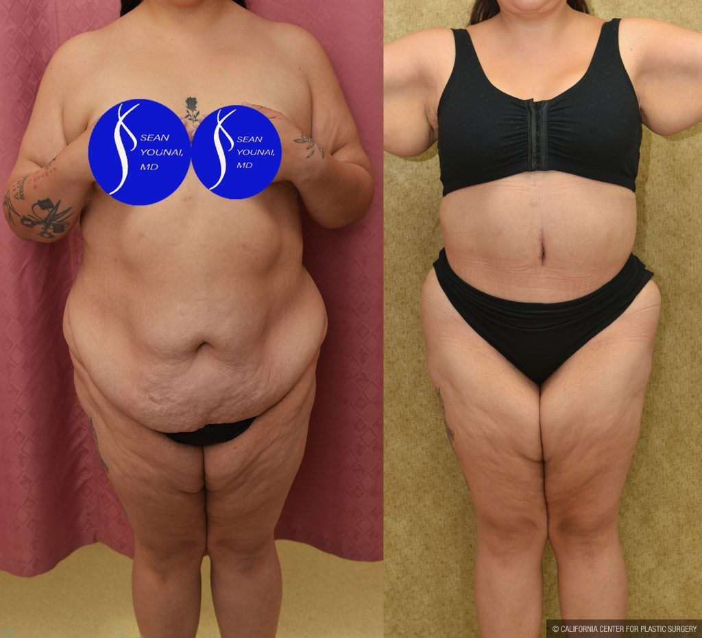Tummy Tuck (Abdominoplasty) Plus Size Before & After Patient #14582