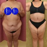 Tummy Tuck (Abdominoplasty) Plus Size Before & After Patient #14582