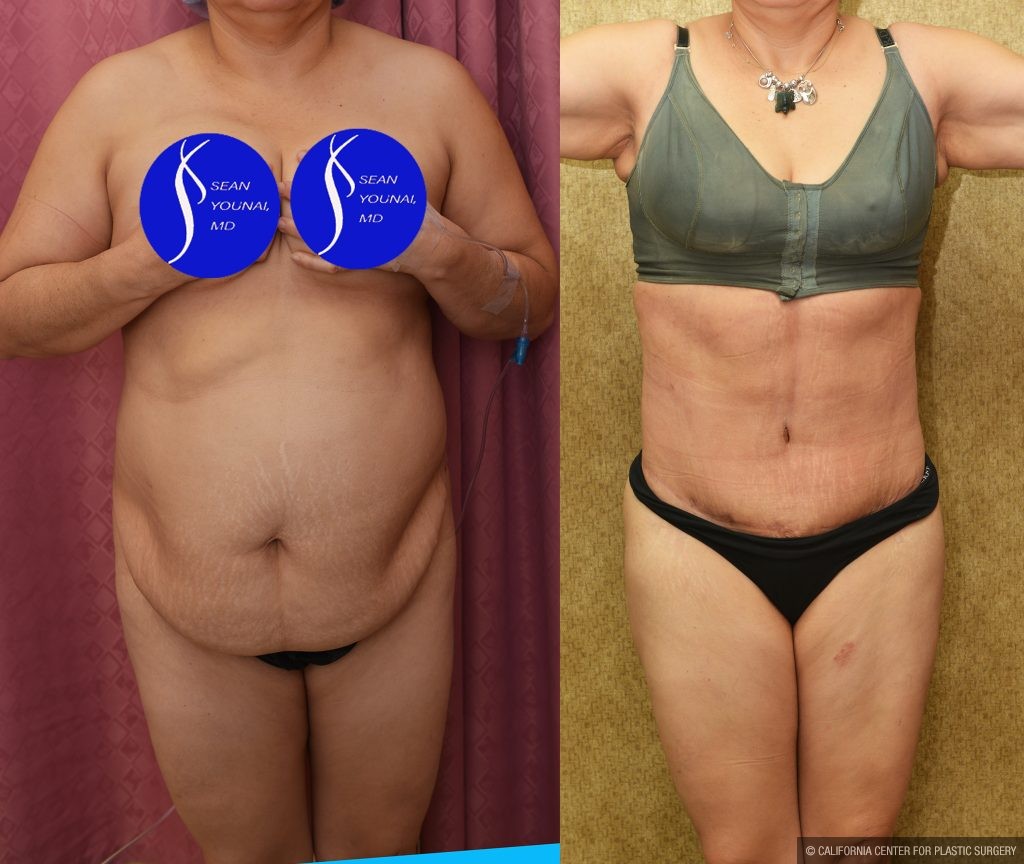 Tummy Tuck (Abdominoplasty) Medium Size Before & After Patient #14583