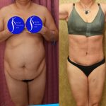 Tummy Tuck (Abdominoplasty) Medium Size Before & After Patient #14583