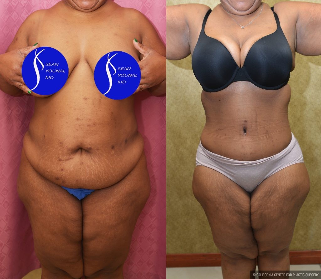 Tummy Tuck (Abdominoplasty) Plus Size Before & After Patient #14584