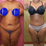 Tummy Tuck (Abdominoplasty) Plus Size Before & After Patient #14584