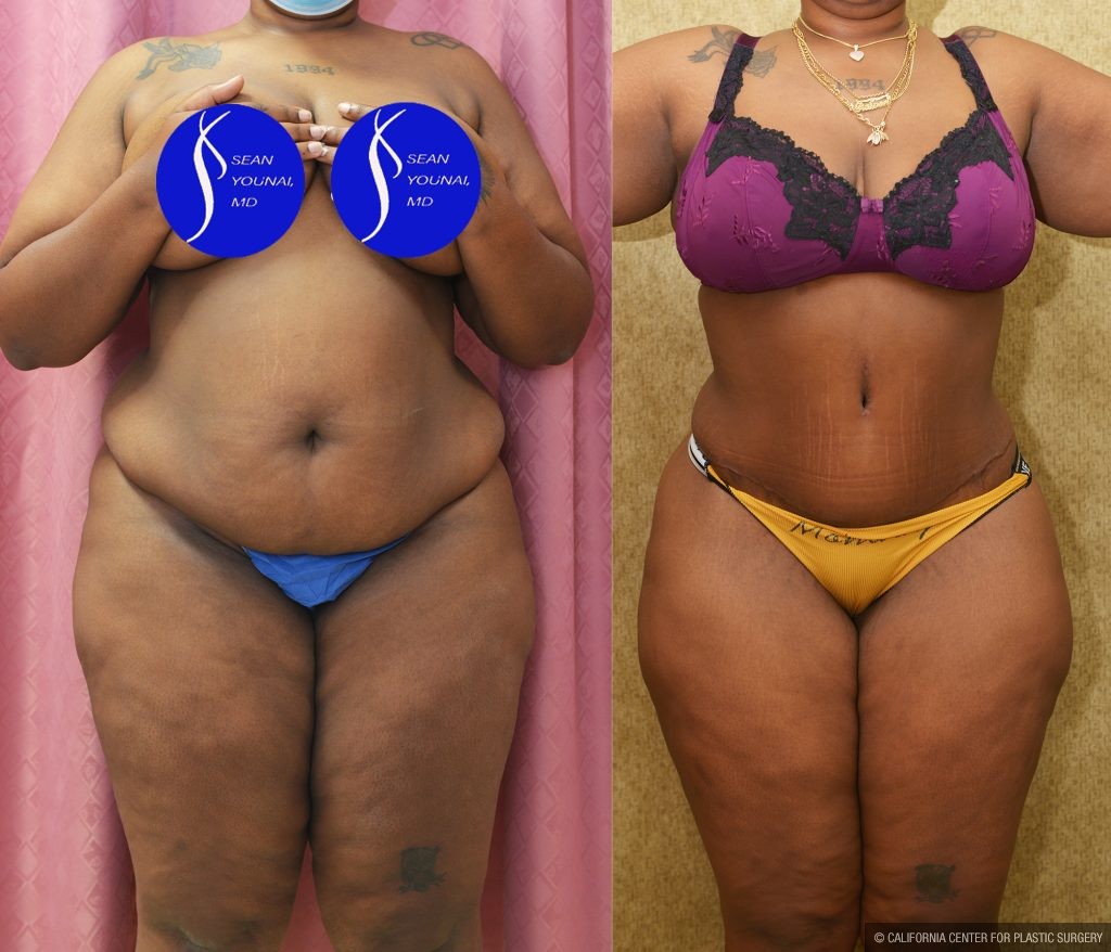 African American Tummy Tuck (Abdominoplasty) Before & After Patient #14585