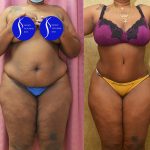 African American Tummy Tuck (Abdominoplasty) Before & After Patient #14585