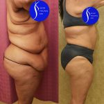 Tummy Tuck (Abdominoplasty) Super Plus Size Before & After Patient #14577