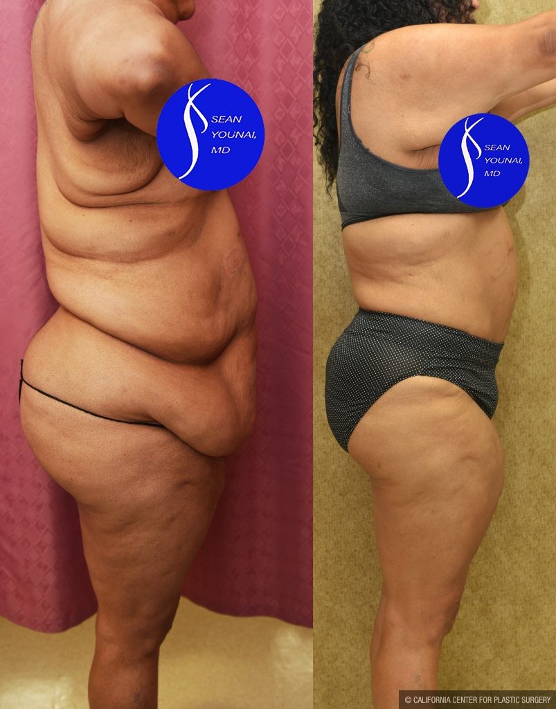 Tummy Tuck (Abdominoplasty) Super Plus Size Before & After Patient #14577