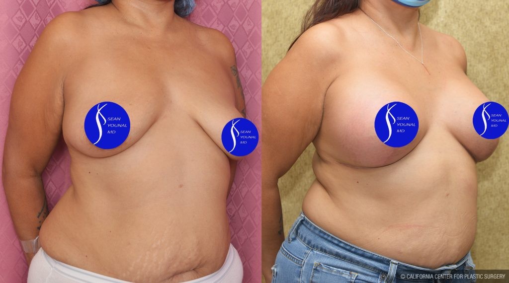 Breast Lift - Full Before & After Patient #14587