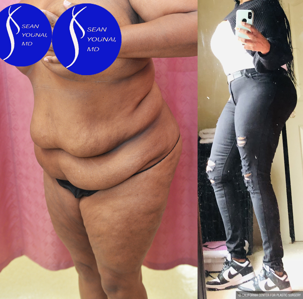 Tummy Tuck (Abdominoplasty) Plus Size Before & After Patient #14576
