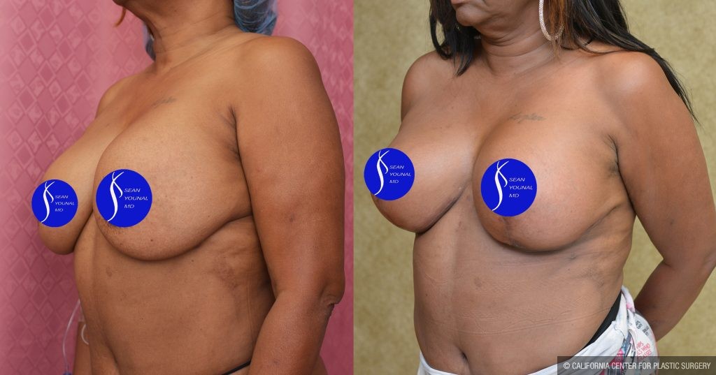 Breast Lift - Full Before & After Patient #14588
