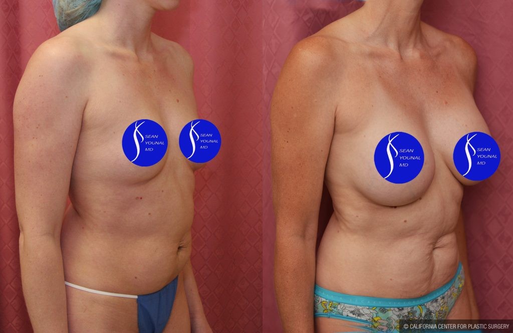 Breast Augmentation Before & After Patient #14589